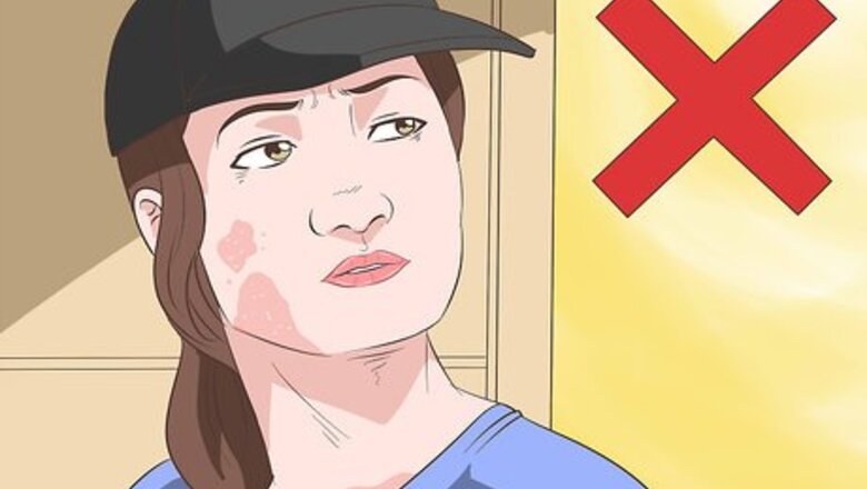 How to Get Rid of Sunburn Fast