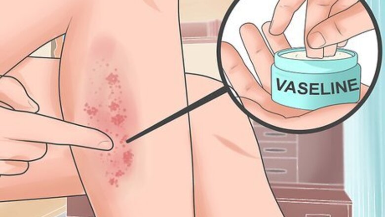 How to Soothe Psoriasis Flares