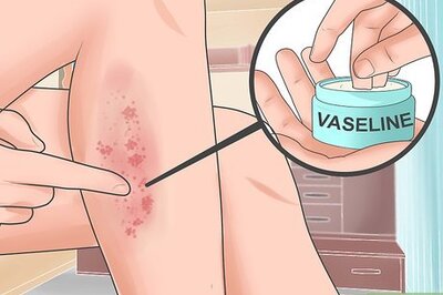 How to Soothe Psoriasis Flares