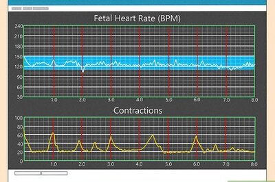 How to Interpret Fetal Heart Rate & Contractions on an Electronic Monitor