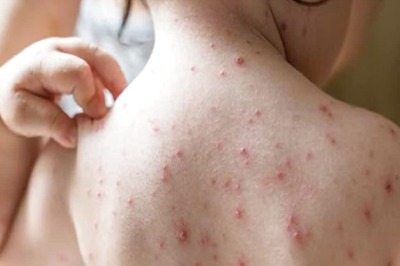 Moringa To Carrot, 4 Foods That May Help Prevent Chicken Pox