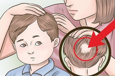 How to Stop Hair Loss in Children