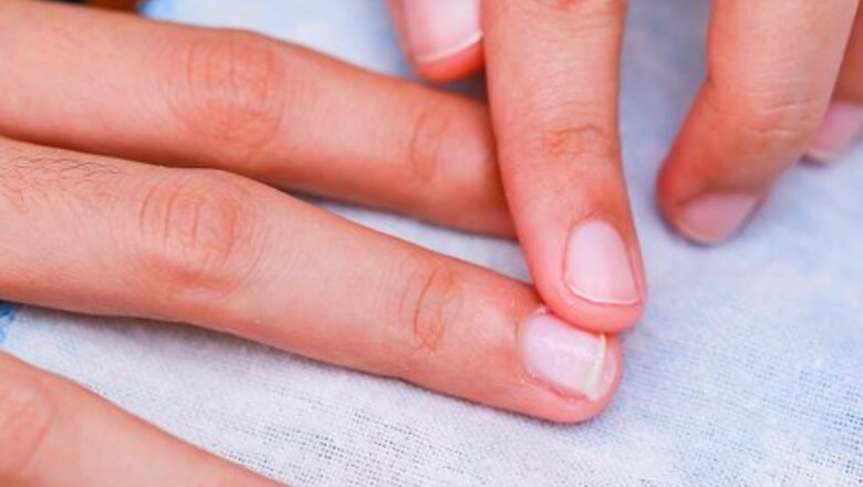 How to Prevent Hangnails