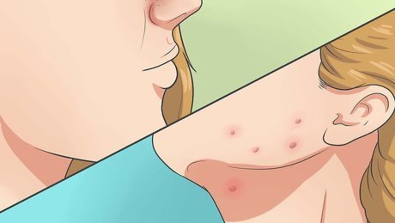 How to Heal Acne Fast and Naturally