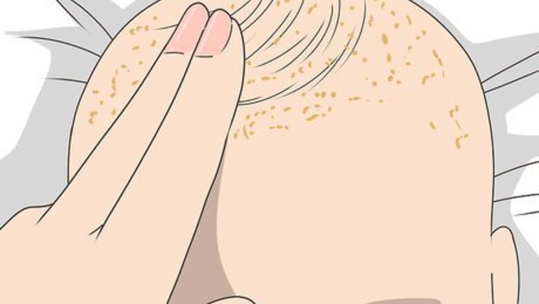 How to Get Rid of Cradle Cap