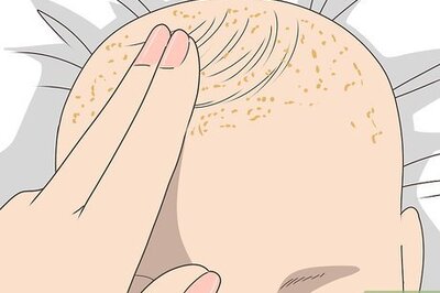 How to Get Rid of Cradle Cap