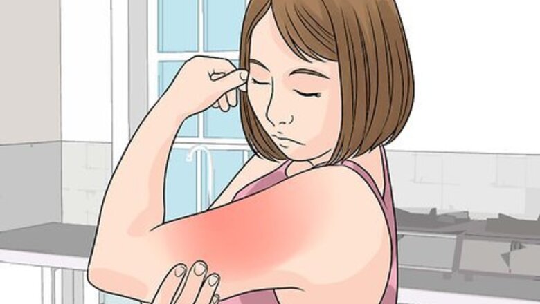 How to Clean a Burn