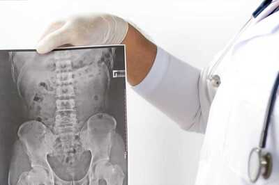 What is Ankylosing Spondylitis And Why Is This Condition Known As A Youngster's Disease?