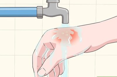 How to Prevent a Burn from Scarring