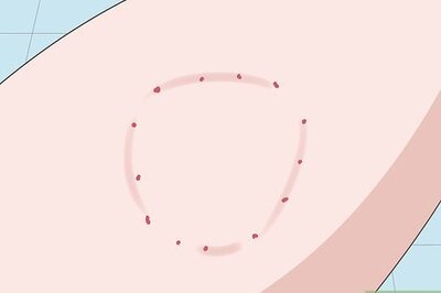 How to Treat a Dog Bite