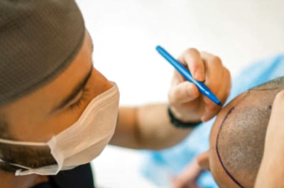 Planning To Undergo Hair Loss Treatment? Check Cost, Procedure And Alternatives