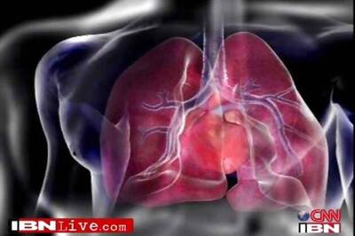 People over 65 die from stroke in developing nations