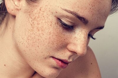Azelaic Acid To Chemical Peels, Cosmetologist Recommends Methods To Treat Hyperpigmentation