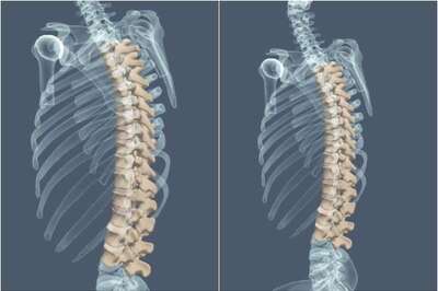 A Silent Spine-related Epidemic Building up, Warns Doctor