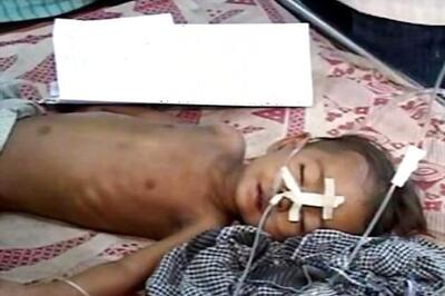 US team reaches Gorakhpur in UP to study about encephalitis