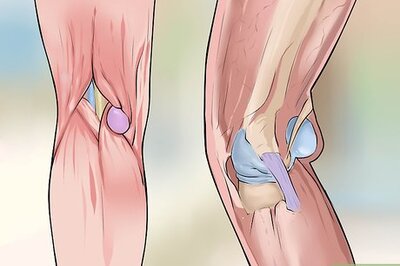 How to Cure a Baker's Cyst