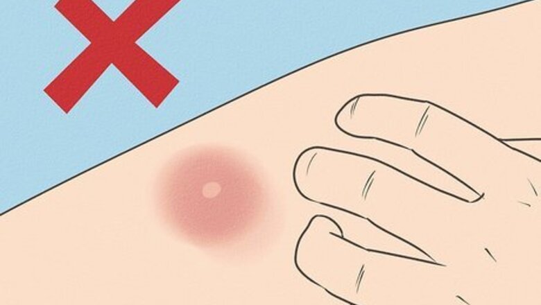 How to Get Rid of a Mosquito Bite
