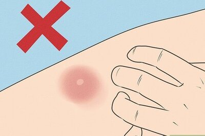 How to Get Rid of a Mosquito Bite