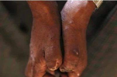 World Leprosy Day 2022: Has Leprosy Been Eradicated Around The World?