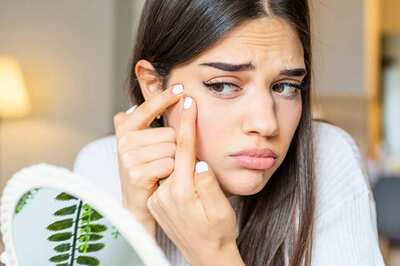 Here are Some Common Myths and Facts about Acne