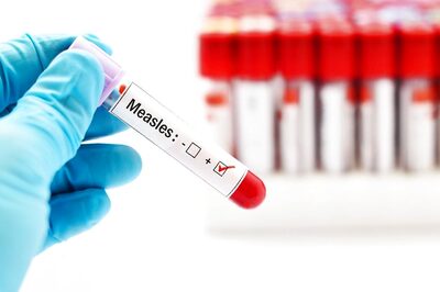 Measles Surge: Country on Alert to Manage Post-Pandemic Crisis