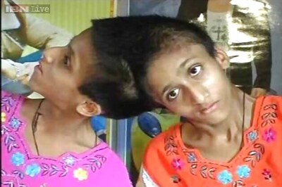 Conjoined twins Saba, Farah in critical condition in Patna hospital