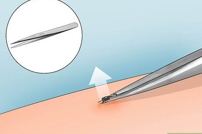 How to Remove an Embedded Tick Head