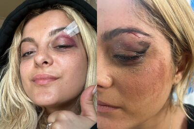 Bebe Rexha Shares Photos Of Injuries After Fan Throws Phone At Her Face: ‘I'M Good’