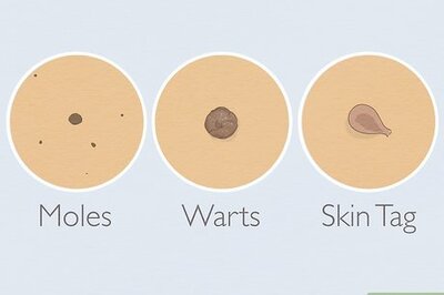 How to Remove a Skin Tag from Your Neck At Home
