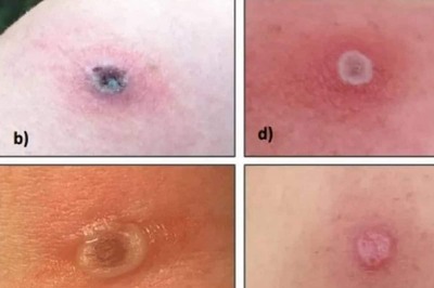 What Is Alaskapox? Explaining Mystery Behind Unusual Virus Spreading In United States