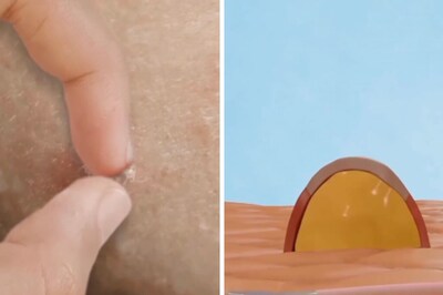 What Happens When You Pop Pimples? Experts Explain The Science Behind It