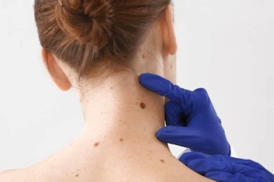 Seborrhoeic Keratosis: All You Need to Know About This Skin Tumour