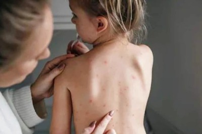 Symptoms Of Chickenpox In Children And A Few Caring Tips