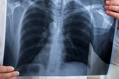 Sharp Covid Rise in UK: From Low Vaccination to Early Curb Relaxations, A Look at What's Fuelling Spike