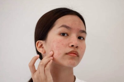 Want To Prevent Acne Scars? 4 Tips That Might Help