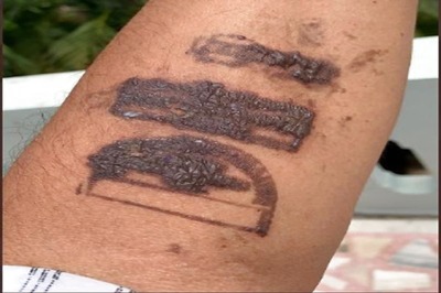 Delhi Airport Discards Batch of Ink as Former MP Tweets Photo of Burns After Being Stamped on Hand