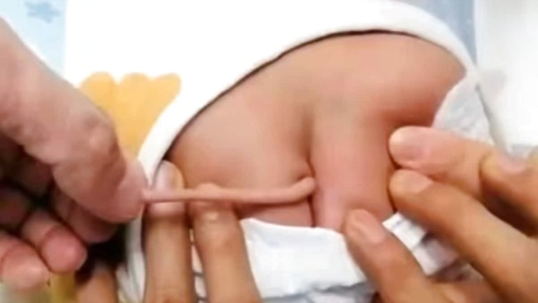 Chinese Baby Born With A Tail Due To Rare Birth Defect Leaves Doctors Confused