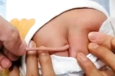 Chinese Baby Born With A Tail Due To Rare Birth Defect Leaves Doctors Confused