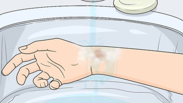 How to Treat Insect Bites in Toddlers