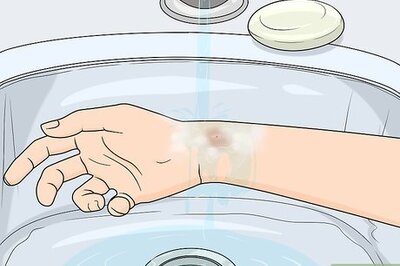 How to Treat Insect Bites in Toddlers